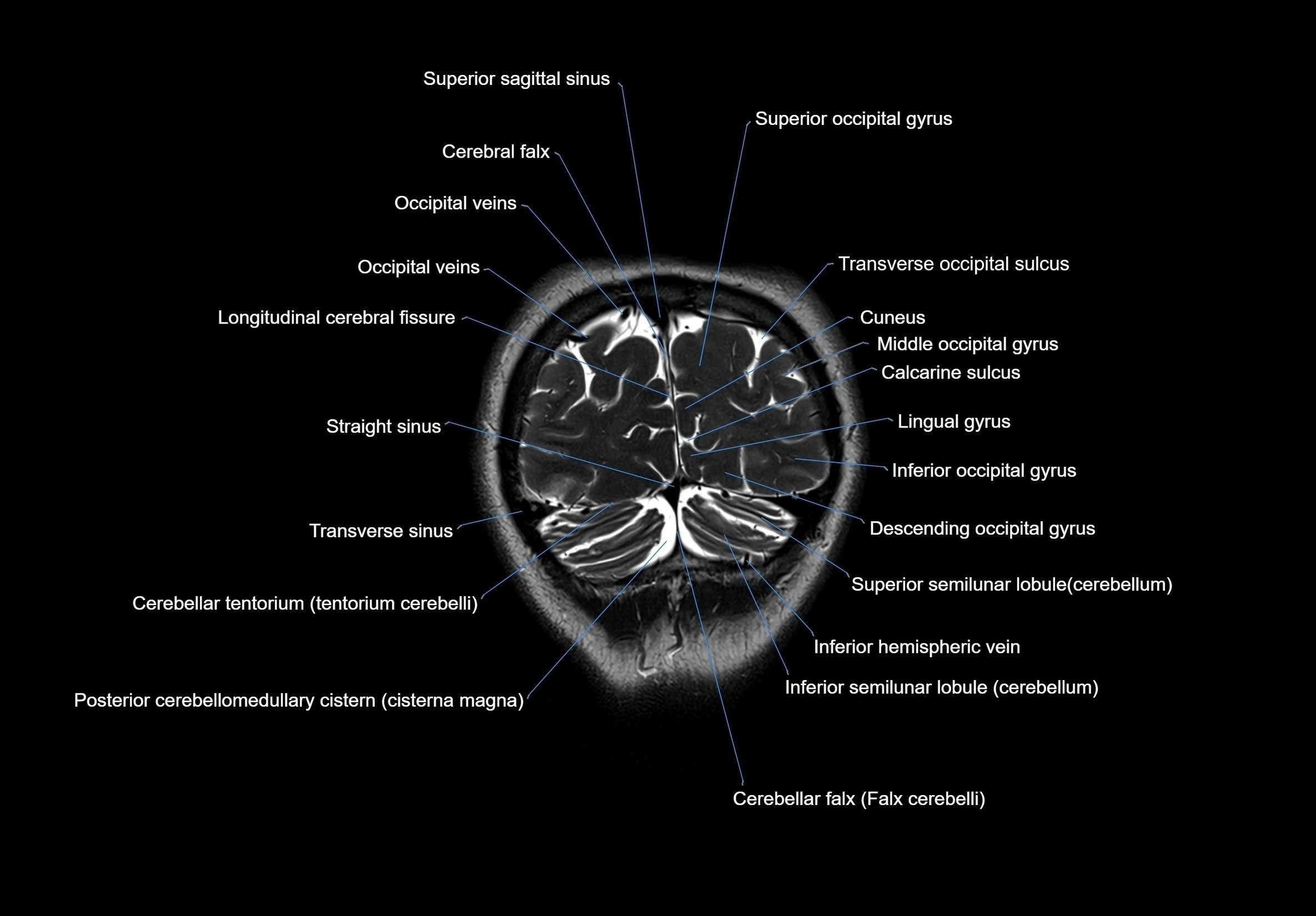 MRI Brain coronal cross sectional labelled anatomy 3T image  -img-00001-00066.webp